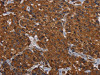 The image on the left is immunohistochemistry of paraffin-embedded Human breast cancer tissue using CSB-PA011966 (HYAL2 Antibody) at dilution 1/60, on the right is treated with fusion protein. (Original magnification: ×200)