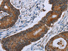 The image on the left is immunohistochemistry of paraffin-embedded Human colon cancer tissue using CSB-PA586287 (IDH2 Antibody) at dilution 1/60, on the right is treated with fusion protein. (Original magnification: ×200)