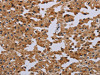 The image on the left is immunohistochemistry of paraffin-embedded Human prostate cancer tissue using CSB-PA698625 (IFRD1 Antibody) at dilution 1/40, on the right is treated with fusion protein. (Original magnification: ×200)