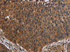 The image on the left is immunohistochemistry of paraffin-embedded Human lung cancer tissue using CSB-PA183080 (FCGR3A Antibody) at dilution 1/60, on the right is treated with fusion protein. (Original magnification: ×200)