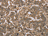 The image on the left is immunohistochemistry of paraffin-embedded Human liver cancer tissue using CSB-PA505319 (IKBIP Antibody) at dilution 1/30, on the right is treated with fusion protein. (Original magnification: ×200)
