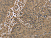 The image on the left is immunohistochemistry of paraffin-embedded Human lung cancer tissue using CSB-PA505319 (IKBIP Antibody) at dilution 1/30, on the right is treated with fusion protein. (Original magnification: ×200)