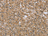 The image on the left is immunohistochemistry of paraffin-embedded Human prostate cancer tissue using CSB-PA843964 (TXLNA Antibody) at dilution 1/30, on the right is treated with fusion protein. (Original magnification: ×200)