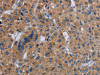 The image on the left is immunohistochemistry of paraffin-embedded Human liver cancer tissue using CSB-PA298467 (IL27RA Antibody) at dilution 1/40, on the right is treated with fusion protein. (Original magnification: ×200)