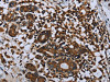 The image on the left is immunohistochemistry of paraffin-embedded Human breast cancer tissue using CSB-PA107902 (IL31RA Antibody) at dilution 1/20, on the right is treated with fusion protein. (Original magnification: ×200)