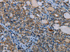 The image on the left is immunohistochemistry of paraffin-embedded Human thyroid cancer tissue using CSB-PA125161 (IL31RA Antibody) at dilution 1/30, on the right is treated with fusion protein. (Original magnification: ×200)