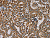 The image on the left is immunohistochemistry of paraffin-embedded Human thyroid cancer tissue using CSB-PA121059 (IPO13 Antibody) at dilution 1/25, on the right is treated with fusion protein. (Original magnification: ×200)