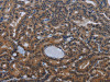 The image on the left is immunohistochemistry of paraffin-embedded Human thyroid cancer tissue using CSB-PA218625 (INSIG2 Antibody) at dilution 1/30, on the right is treated with fusion protein. (Original magnification: ×200)