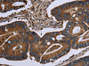 The image on the left is immunohistochemistry of paraffin-embedded Human colon cancer tissue using CSB-PA249653 (ITGA2B Antibody) at dilution 1/40, on the right is treated with fusion protein. (Original magnification: ×200)