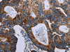 The image on the left is immunohistochemistry of paraffin-embedded Human colon cancer tissue using CSB-PA571561 (F11R Antibody) at dilution 1/40, on the right is treated with fusion protein. (Original magnification: ×200)