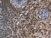 The image on the left is immunohistochemistry of paraffin-embedded Human cervical cancer tissue using CSB-PA052445 (KDM3B Antibody) at dilution 1/40, on the right is treated with fusion protein. (Original magnification: ×200)