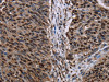 The image on the left is immunohistochemistry of paraffin-embedded Human lung cancer tissue using CSB-PA980184 (KDM3B Antibody) at dilution 1/50, on the right is treated with fusion protein. (Original magnification: ×200)