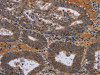 The image on the left is immunohistochemistry of paraffin-embedded Human colon cancer tissue using CSB-PA292777 (JMJD7 Antibody) at dilution 1/30, on the right is treated with fusion protein. (Original magnification: ×200)