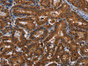 The image on the left is immunohistochemistry of paraffin-embedded Human thyroid cancer tissue using CSB-PA991655 (JMJD7 Antibody) at dilution 1/20, on the right is treated with fusion protein. (Original magnification: ×200)