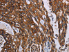 The image on the left is immunohistochemistry of paraffin-embedded Human colon cancer tissue using CSB-PA163096 (KARS Antibody) at dilution 1/60, on the right is treated with fusion protein. (Original magnification: ×200)