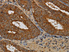 The image on the left is immunohistochemistry of paraffin-embedded Human colon cancer tissue using CSB-PA972784 (KCNK17 Antibody) at dilution 1/60, on the right is treated with fusion protein. (Original magnification: ×200)