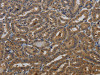 The image on the left is immunohistochemistry of paraffin-embedded Human thyroid cancer tissue using CSB-PA183860 (KCNK17 Antibody) at dilution 1/50, on the right is treated with fusion protein. (Original magnification: ×200)