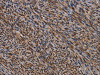 The image on the left is immunohistochemistry of paraffin-embedded Human sarcoma tissue using CSB-PA969739 (KIF1C Antibody) at dilution 1/60, on the right is treated with fusion protein. (Original magnification: ×200)