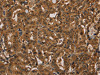 The image on the left is immunohistochemistry of paraffin-embedded Human thyroid cancer tissue using CSB-PA966542 (KIF20A Antibody) at dilution 1/20, on the right is treated with fusion protein. (Original magnification: ×200)