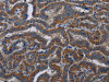 The image on the left is immunohistochemistry of paraffin-embedded Human thyroid cancer tissue using CSB-PA562259 (KLK11 Antibody) at dilution 1/40, on the right is treated with fusion protein. (Original magnification: ×200)