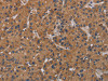 The image on the left is immunohistochemistry of paraffin-embedded Human liver cancer tissue using CSB-PA374084 (KLK13 Antibody) at dilution 1/20, on the right is treated with fusion protein. (Original magnification: ×200)