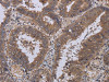 The image on the left is immunohistochemistry of paraffin-embedded Human colon cancer tissue using CSB-PA242915 (LEPREL2 Antibody) at dilution 1/40, on the right is treated with fusion protein. (Original magnification: ×200)