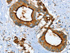 The image on the left is immunohistochemistry of paraffin-embedded Human colon cancer tissue using CSB-PA594413 (LGALS3BP Antibody) at dilution 1/25, on the right is treated with fusion protein. (Original magnification: ×200)