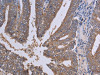 The image on the left is immunohistochemistry of paraffin-embedded Human colon cancer tissue using CSB-PA795414 (LIMS1 Antibody) at dilution 1/30, on the right is treated with fusion protein. (Original magnification: ×200)