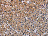 The image on the left is immunohistochemistry of paraffin-embedded Human prostate cancer tissue using CSB-PA196351 (ACP6 Antibody) at dilution 1/50, on the right is treated with fusion protein. (Original magnification: ×200)