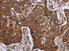 The image on the left is immunohistochemistry of paraffin-embedded Human liver cancer tissue using CSB-PA959682 (ACP6 Antibody) at dilution 1/30, on the right is treated with fusion protein. (Original magnification: ×200)