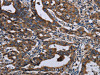 The image on the left is immunohistochemistry of paraffin-embedded Human gastic cancer tissue using CSB-PA217118 (LZTFL1 Antibody) at dilution 1/50, on the right is treated with fusion protein. (Original magnification: ×200)