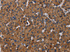 The image on the left is immunohistochemistry of paraffin-embedded Human liver cancer tissue using CSB-PA568879 (LZTFL1 Antibody) at dilution 1/30, on the right is treated with fusion protein. (Original magnification: ×200)