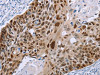 The image on the left is immunohistochemistry of paraffin-embedded Human esophagus cancer tissue using CSB-PA216191 (MAGEA10 Antibody) at dilution 1/50, on the right is treated with fusion protein. (Original magnification: ×200)