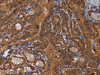 The image on the left is immunohistochemistry of paraffin-embedded Human thyroid cancer tissue using CSB-PA202304 (MAGEB10 Antibody) at dilution 1/60, on the right is treated with fusion protein. (Original magnification: ×200)