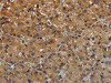 The image on the left is immunohistochemistry of paraffin-embedded Human liver cancer tissue using CSB-PA958657 (TAB1 Antibody) at dilution 1/40, on the right is treated with fusion protein. (Original magnification: ×200)