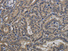 The image on the left is immunohistochemistry of paraffin-embedded Human thyroid cancer tissue using CSB-PA958657 (TAB1 Antibody) at dilution 1/40, on the right is treated with fusion protein. (Original magnification: ×200)