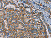 The image is immunohistochemistry of paraffin-embedded Human thyroid cancer tissue using CSB-PA133615 (TAB3 Antibody) at dilution 1/25. (Original magnification: ×200)