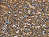 The image is immunohistochemistry of paraffin-embedded Human thyroid cancer tissue using CSB-PA910574 (TAB3 Antibody) at dilution 1/35. (Original magnification: ×200)