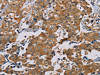 The image is immunohistochemistry of paraffin-embedded Human thyroid cancer tissue using CSB-PA910574 (TAB3 Antibody) at dilution 1/35. (Original magnification: ×200)