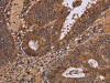 The image on the left is immunohistochemistry of paraffin-embedded Human colon cancer tissue using CSB-PA248639 (WDR83 Antibody) at dilution 1/30, on the right is treated with fusion protein. (Original magnification: ×200)