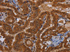 The image on the left is immunohistochemistry of paraffin-embedded Human thyroid cancer tissue using CSB-PA552938 (WDR83 Antibody) at dilution 1/60, on the right is treated with fusion protein. (Original magnification: ×200)