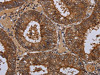The image on the left is immunohistochemistry of paraffin-embedded Human colon cancer tissue using CSB-PA552938 (WDR83 Antibody) at dilution 1/60, on the right is treated with fusion protein. (Original magnification: ×200)