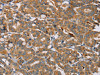 The image is immunohistochemistry of paraffin-embedded Human thyroid cancer tissue using CSB-PA567465 (MBNL3 Antibody) at dilution 1/20. (Original magnification: ×200)