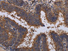 The image on the left is immunohistochemistry of paraffin-embedded Human colon cancer tissue using CSB-PA972492 (MCTS1 Antibody) at dilution 1/30, on the right is treated with fusion protein. (Original magnification: ×200)