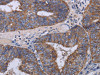 The image on the left is immunohistochemistry of paraffin-embedded Human colon cancer tissue using CSB-PA520082 (MT3 Antibody) at dilution 1/50, on the right is treated with fusion protein. (Original magnification: ×200)