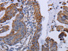 The image on the left is immunohistochemistry of paraffin-embedded Human esophagus cancer tissue using CSB-PA520082 (MT3 Antibody) at dilution 1/50, on the right is treated with fusion protein. (Original magnification: ×200)