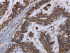 The image on the left is immunohistochemistry of paraffin-embedded Human esophagus cancer tissue using CSB-PA789465 (MT3 Antibody) at dilution 1/50, on the right is treated with fusion protein. (Original magnification: ×200)