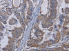 The image on the left is immunohistochemistry of paraffin-embedded Human esophagus cancer tissue using CSB-PA969456 (TRPM8 Antibody) at dilution 1/30, on the right is treated with fusion protein. (Original magnification: ×200)