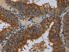 The image on the left is immunohistochemistry of paraffin-embedded Human colon cancer tissue using CSB-PA560273 (MIER2 Antibody) at dilution 1/50, on the right is treated with fusion protein. (Original magnification: ×200)