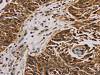The image on the left is immunohistochemistry of paraffin-embedded Human lung cancer tissue using CSB-PA124380 (MRPL11 Antibody) at dilution 1/20, on the right is treated with fusion protein. (Original magnification: ×200)